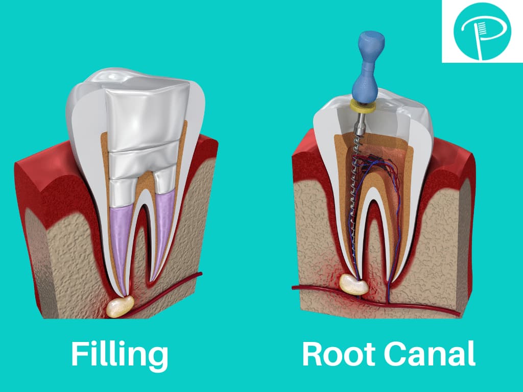 Endodontics (Root Canal Treatment)